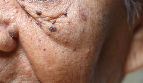 dermatosis papulosa nigra legacy dermatology algonquin il