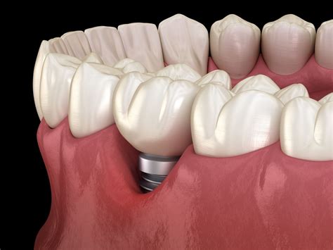 How Certain Medications Affect Dental Implants | Chicago Dental Implants