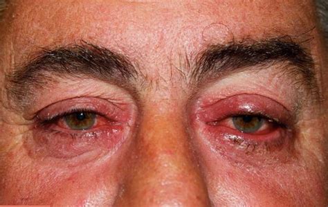 Ocular Rosacea - Causes, Triggers, Symptoms, Eye Drops, Treatment