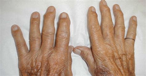 Research Identifies Potential Protein for Preventing Osteoarthritis ...