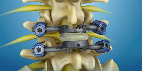 Spinal Stenosis Treatment | TOPS™ System by Premia Spine