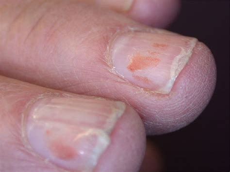 Split Nails: Pictures, Causes, and Treatments