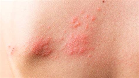 le zona  symptomes traitements