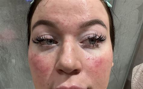 Results from 1 week of using Ivermectin : r/Rosacea