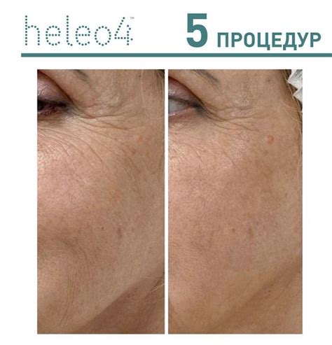 Фототерапия Heleo 4