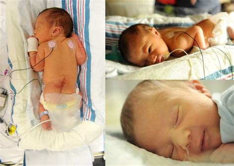 My Child Doesn't 'Suffer' From Spina Bifida | Spina bifida, Spina ...