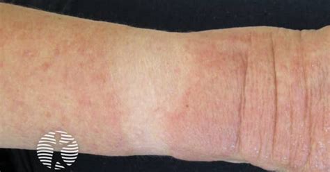 photosensitivity image