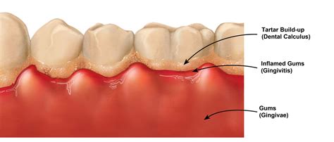 Why do I keep getting tartar build ups when I brush every day? | News