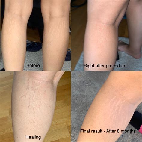 Famous stretch mark camouflage - not worth it, girl was trained in