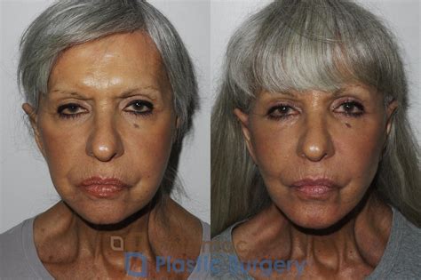 Face Lifts Before And After