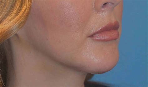 chin implant utah facial plastics