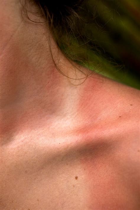 Understanding & Managing Skin Rashes: Symptoms & Treatments