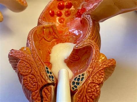 Ülseratif Kolit ve Crohn - Ankara Gastroenteroloji ve İç Hastalıkları ...