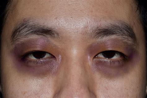 Mengenal Raccoon Eye, Kondisi Memar di Sekitar Kedua Mata