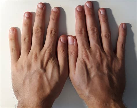 fingers - Why are my nails not symmetric (shorter on left hand