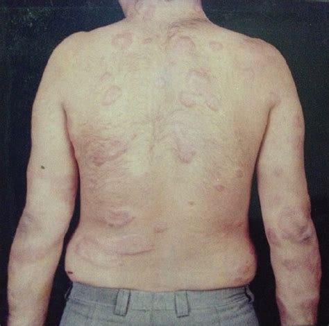 Borderline lepromatous leprosy - WikiProjectMed