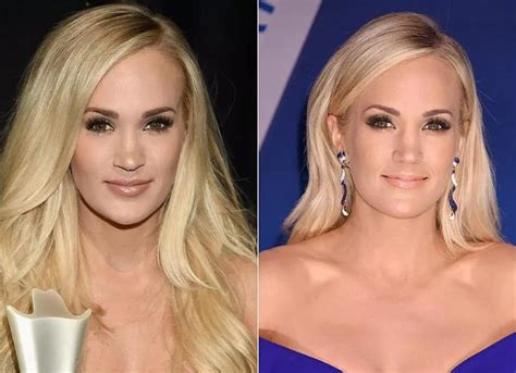 Carrie Underwood Plastic Surgery: Did She Get Lip Surgery?