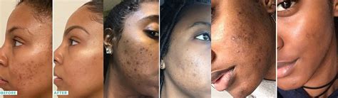 Kojic Acid Soap: Does It Really Work? - Hunter Games Magazine