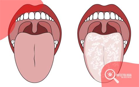 Pontinho Branco Na Lingua Que Doi - Lingua De Sifilis Primaria Clinical Manifestations Of Syphilis In The