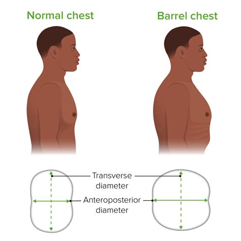 Copd Leads To A Barrel Chest Because It Causes - PELAJARAN