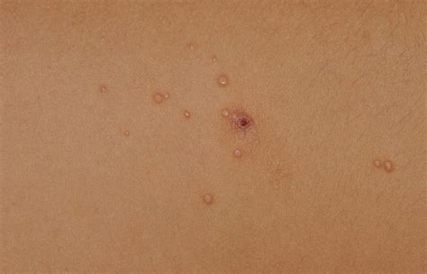 How Long Does Molluscum Contagiosum Stay On Surfaces at Karen Baptiste blog