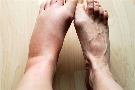 Foot Swelling and Gout Treatment | Singapore Sports and Orthopaedic ...