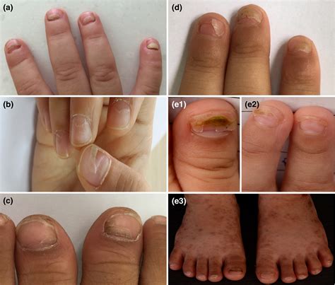Onychomadesis In Toddlers