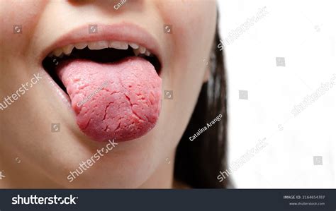 11 Folded Glossitis Images, Stock Photos & Vectors | Shutterstock