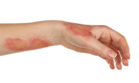 How to Heal a Burn?