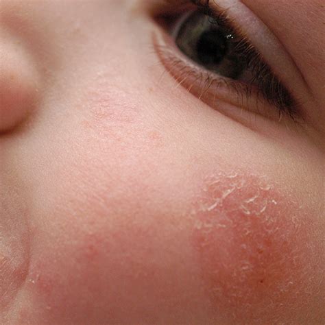 eczema dean dermatology skin therapy