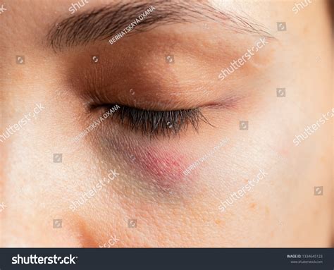 Hematoma Under Eye Stock Photo (Edit Now) 1334645123