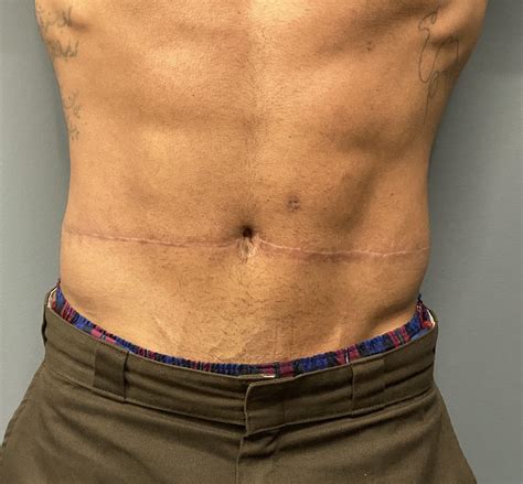 malew mid-abdominal tuck scar result arms raised Dr Barry EppleyJPG