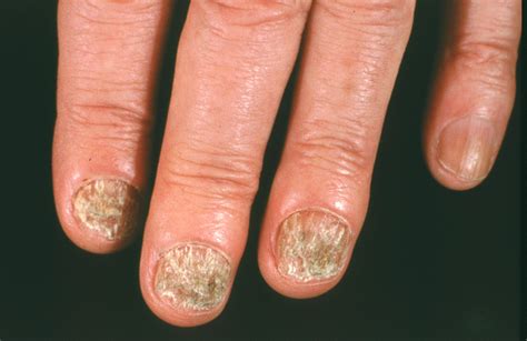 Nail fungus: Foothill Dermatology Medical Center: Dermatology
