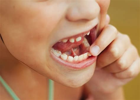 Tooth Mobility: Symptoms, Causes, and 2 Essential Treatments