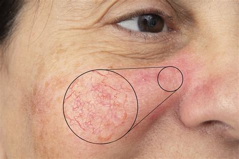 Broken Capillaries – Cause and Treatment | Ask a Dermatologist