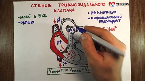 Стеноз трёхстворчатого клапана - "Просто о сложном" - YouTube