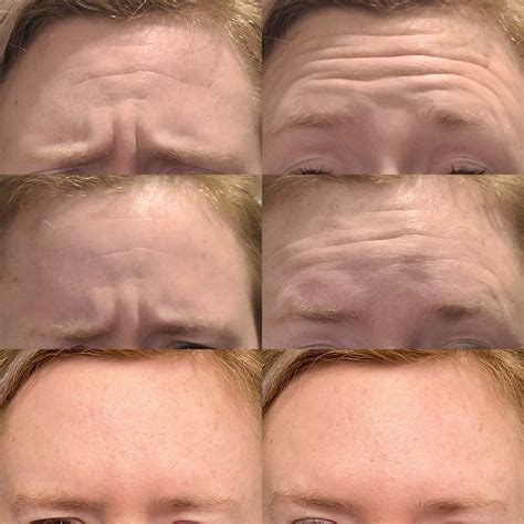 Botox Dysport & Daxxify | Denver City, Lubbock, TX & Hobbs, NM — BEAUTY
