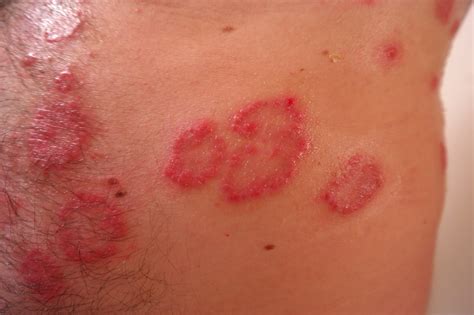 Patients with Eczema, Psoriasis and Xerosis | Pharmacy ITK