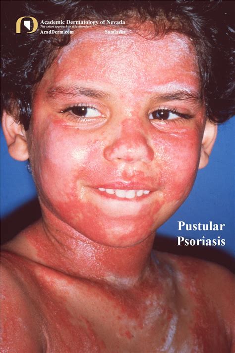 Pustular Psoriasis Face
