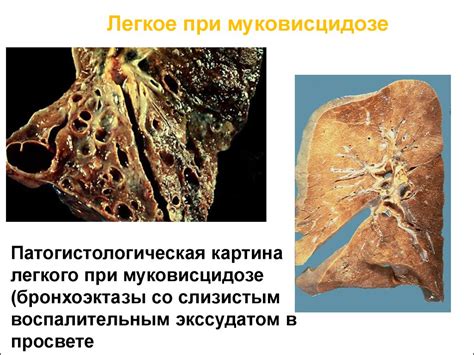 Муковисцидоз - презентация онлайн