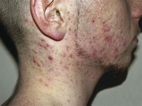 Acné : que prescrire en attendant l’avis du dermatologue ? | La Revue ...