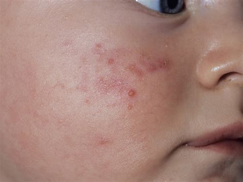 Assadura Com Bolinhas Bebe - Assadura no bebê | BabyCenter