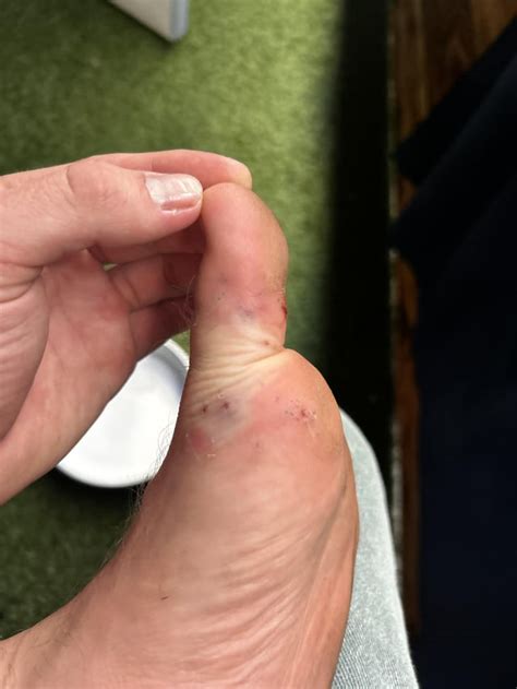 Confused about sea urchin sting, looking for advice : r/surfing