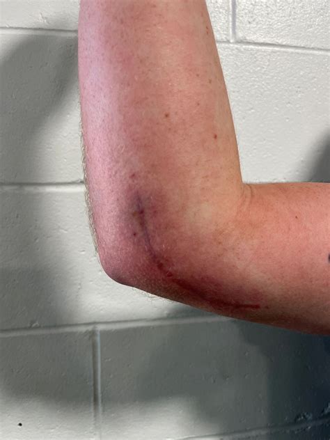 WHAT IS TOMMY JOHN SURGERY?