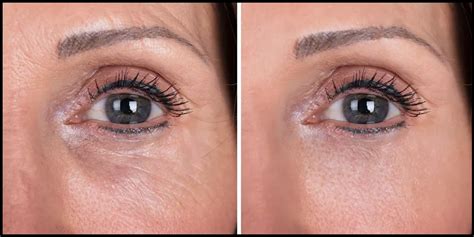 Ultherapy Under Eyes - Nell Laser & Cosmetic Clinic | Toronto, North York