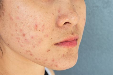 closeup  woman  face  problems  acne inflammation