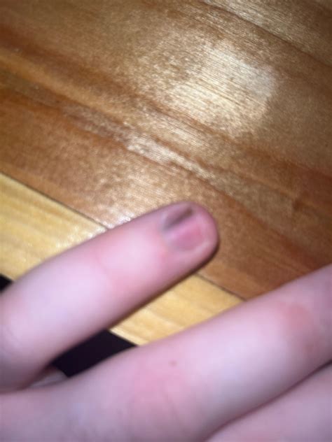 Got a splinter under my nail tried digging out with tweezers and nail