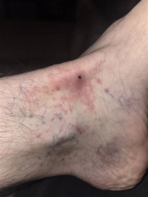 Brown Recluse Bite Pictures Timeline