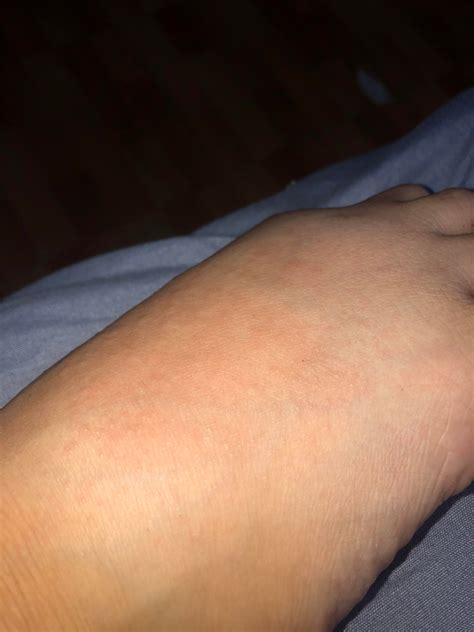 Woke up to a cluster of very tiny, itchy bumps on my foot : r/bugbites