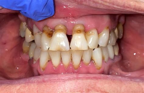 Implant Restorations
